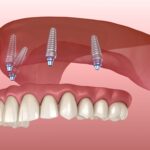 dental Implant Aberdeen